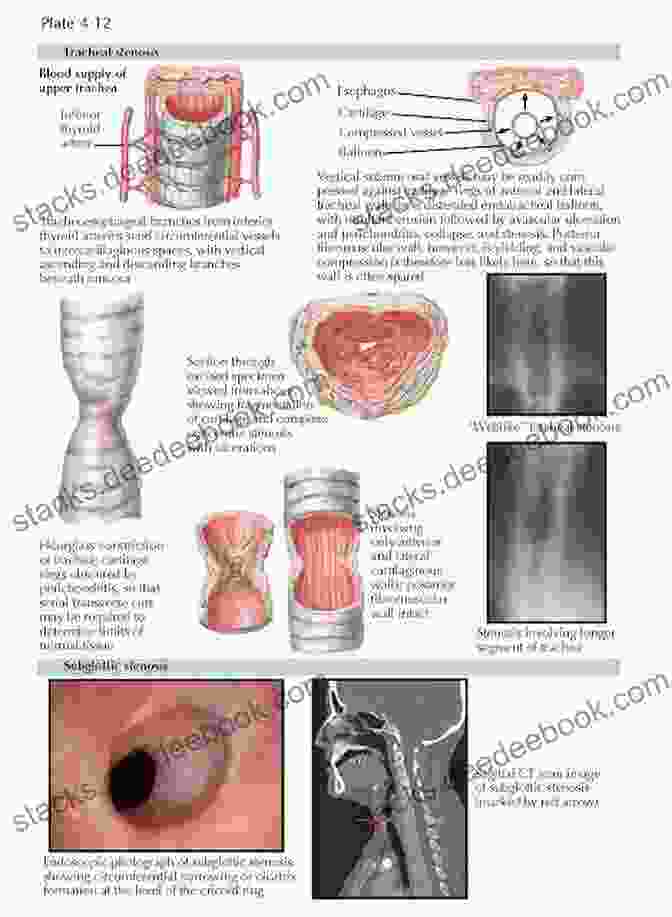 Laryngeal Stenosis LARYNGEAL PATHOLOGY IN IMAGES Beila Pire De Bastidas