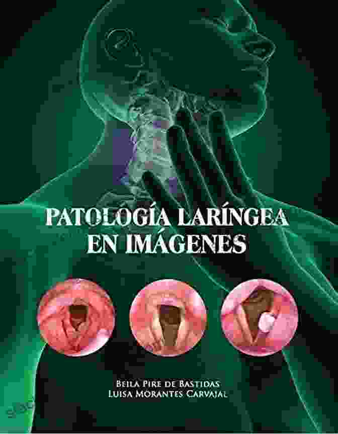 Laryngeal Web LARYNGEAL PATHOLOGY IN IMAGES Beila Pire De Bastidas