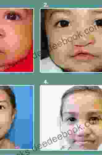 Surgical Management Of Cleft Lip And Palate: A Comprehensive Atlas